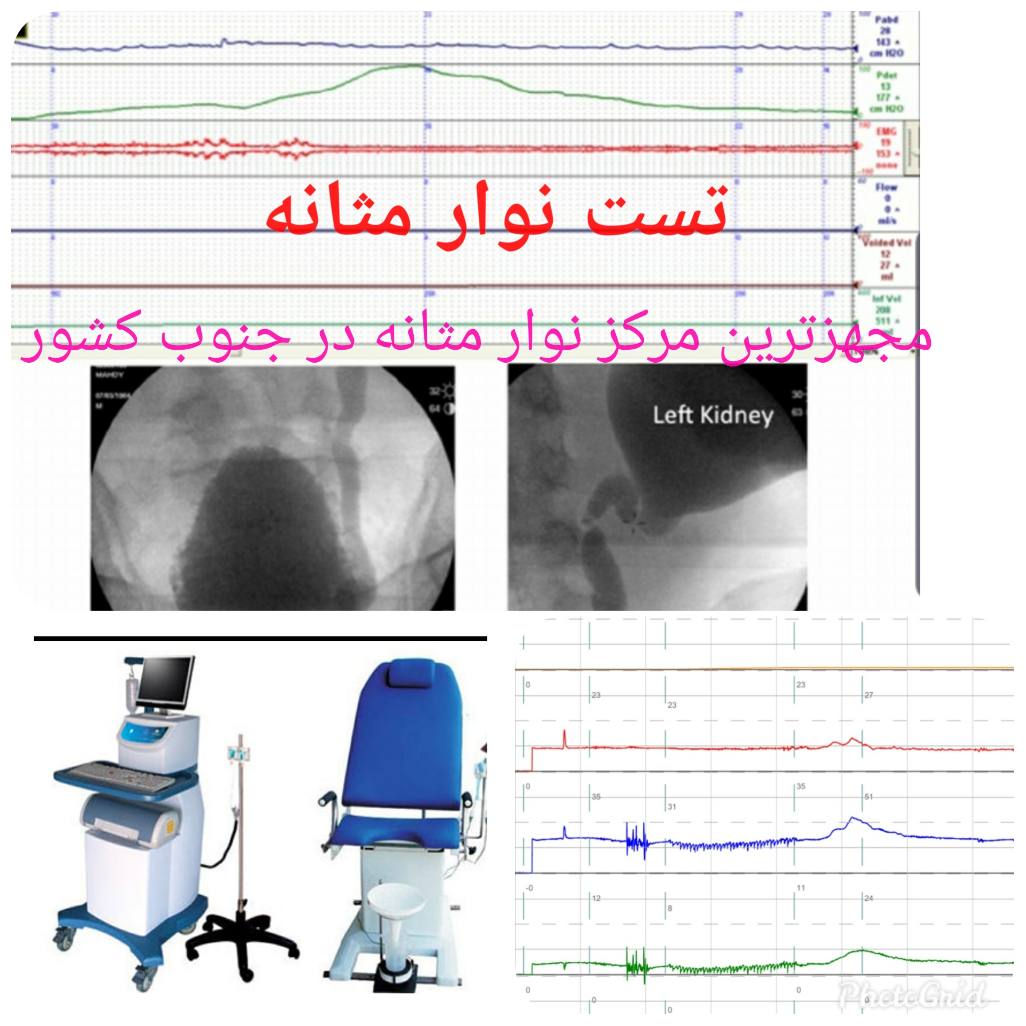 تست نوار مثانه