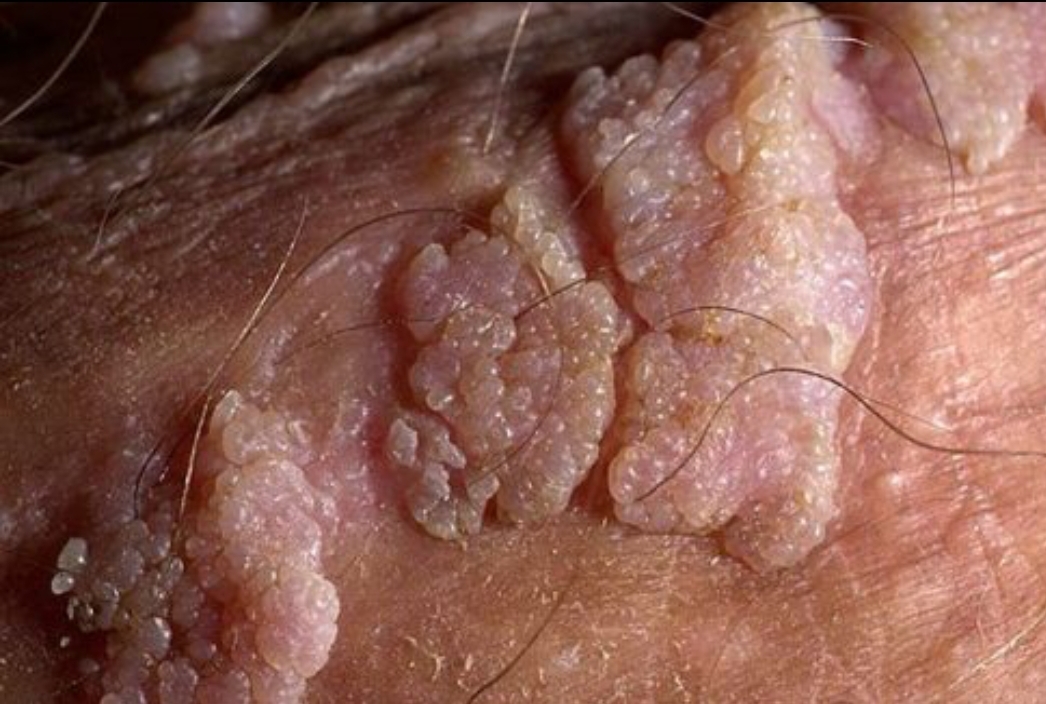 زگیل تناسلی یا genital wart را بهتر بشناسیم.