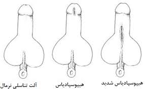 هایپوسپادیاس(نابه جا قرار گرفتن سوراخ خروجی ادرار)