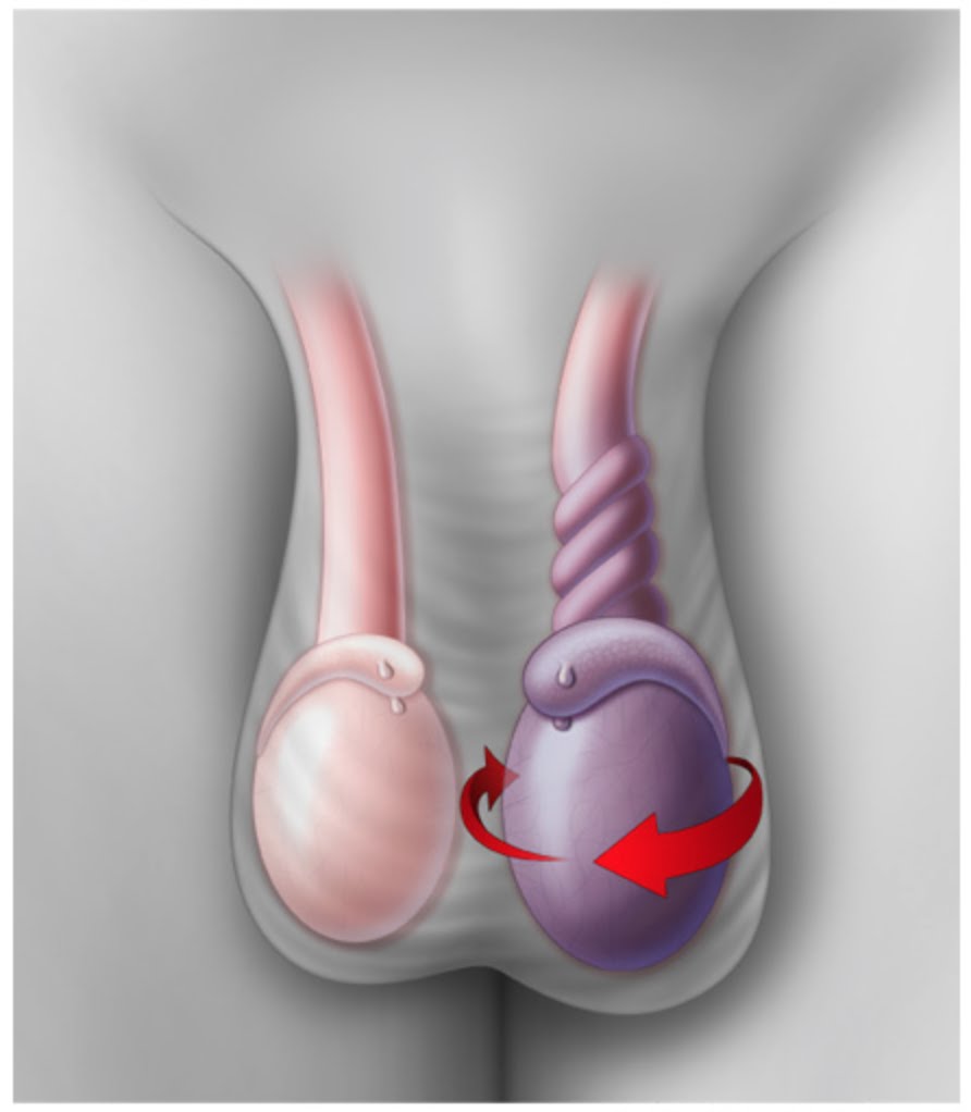 پیچ خوردگی بیضه